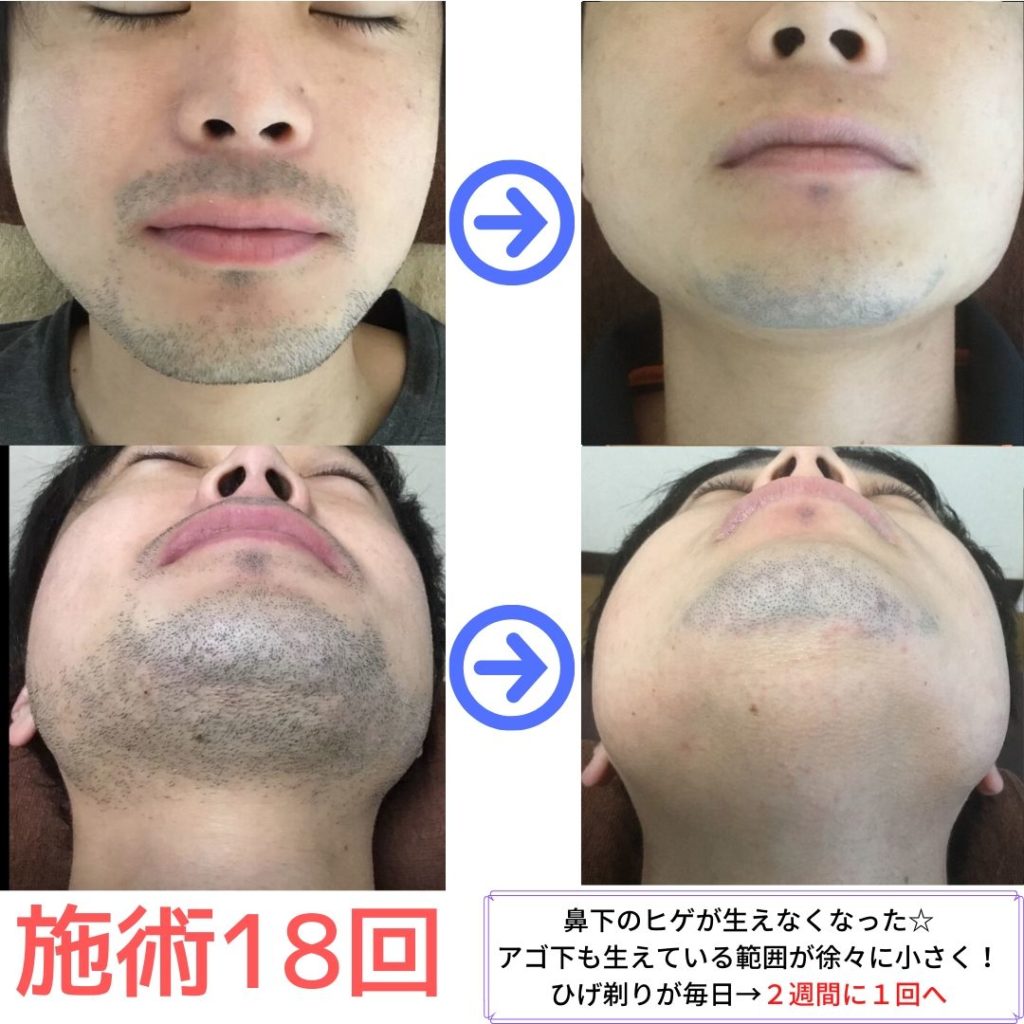 ヒゲ脱毛　１８回